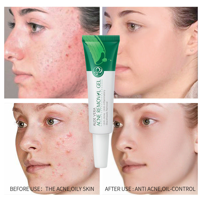 Aloe Acne Treatment Gel Face Cream